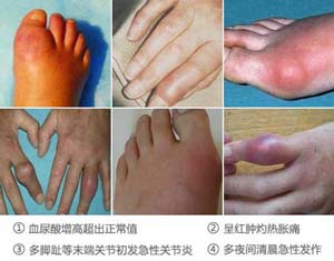 痛风早期症状.jpg